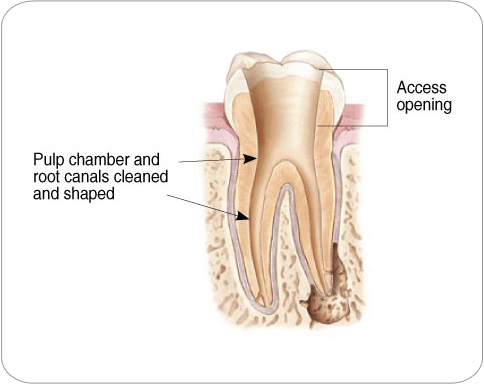 Endodontic Procedure: Crown Opening