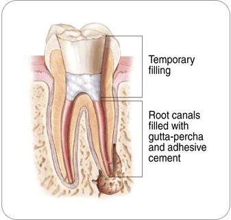 Endodontic Procedure: Temporary Filling