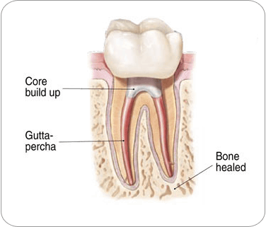 Endodontic Procedure: Crown or Restoration placement