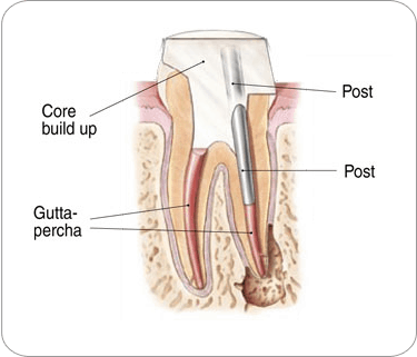Endodontic Procedure: post placement