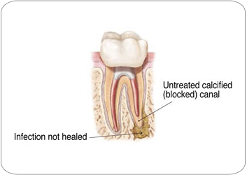 Endodontic Retreatment - Untreated canal