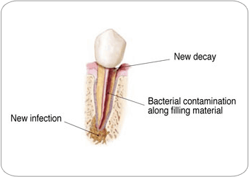 Endodontic Retreatment - New Decay