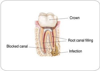 Endodontic Retreatment Options
