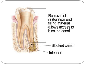 Endodontic Retreatment - Removing canal filling