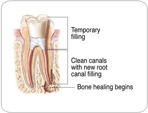 Endodontic Retreatment - Temporary Filling