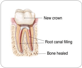 Endodontic Retreatment - New Crown
