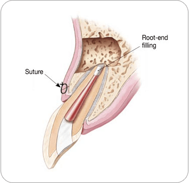 Apicoectomy - Seal root canal